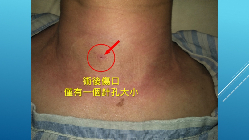 上班族頸腫瘤近四公分 消融術除病灶保留器官