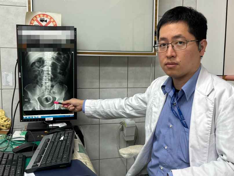 瓷杯爆菊花!男3天無法解便  醫開刀急取出