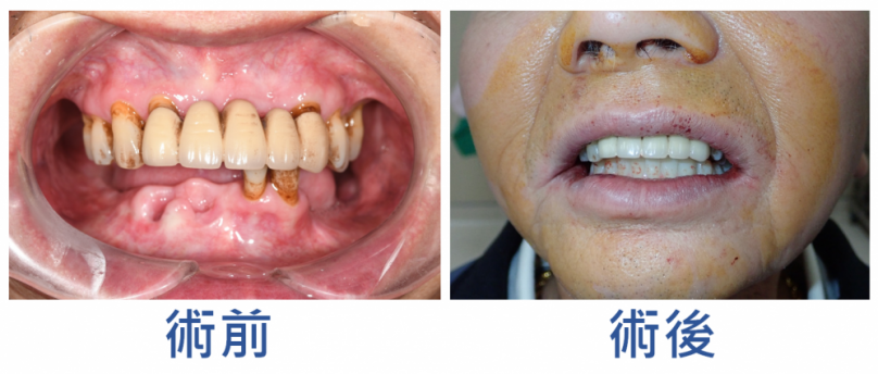 放化療後缺牙難重建　中醫大市醫以3D導航All-on-4植牙助患者恢復咀嚼功能