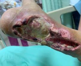 醫師阿  我的腳很重要  我不想被截肢!動脈繞道手術約四個月讓傷口完全癒合