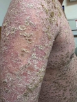 基因突變合併新冠感染　中山附醫發現罕見全身性膿疱乾癬案例